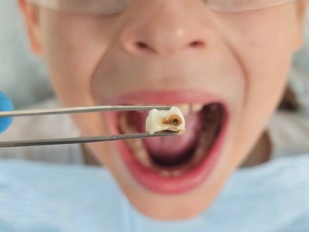 Best Emergency Treatment for Dental Infections or Abscesses in Greenwood, LA